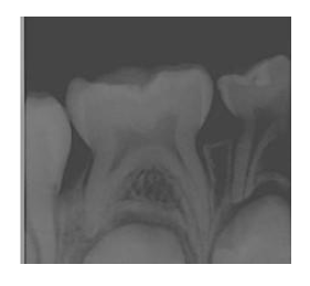 Radiographic image of tooth with cavity