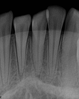 luxated teeth definition