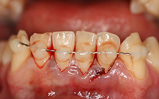 lateral luxation deciduous teeth
