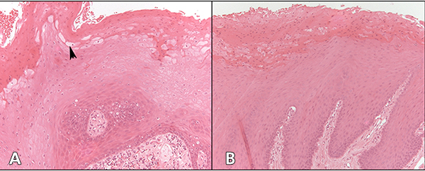 Oral Hairy Leukoplakia in Patients With No Evidence of