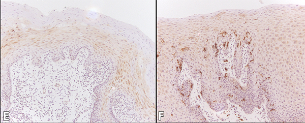 Oral Hairy Leukoplakia in Patients With No Evidence of