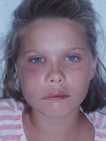 cellulitis cheek