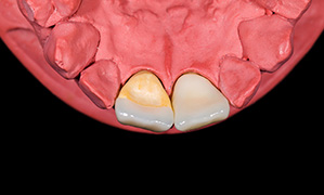Esthetic Rehabilitation Of The Smile With Partial Laminate Veneers In An Older Adult Ceinos 2018 Clinical Case Reports Wiley Online Library