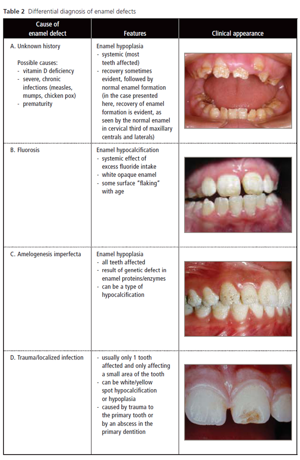 enamel hypoplasia