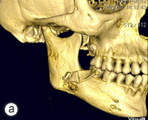 osteomyelitis jaw after wisdom teeth extraction