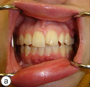 osteomyelitis jaw after wisdom teeth extraction