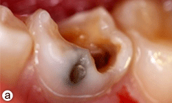 Abces Cerebral Consecutif A Une Infection Dentaire Chez Un Garcon De 11 Ans Une Etude De Cas Jcda