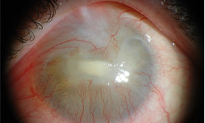 Loss Of Sight Caused By Calcium Hydroxide Paste Accidentally Splashed Into The Eye During Endodontic Treatment Case Report Jcda