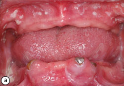 pseudomembranous candidiasis