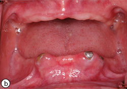 pseudomembranous candidiasis