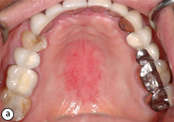 Erythematous candidiasis shop