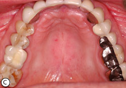 Oral thrush deals roof of mouth