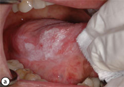 hyperplastic candidiasis