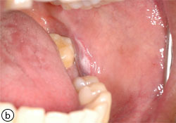 hyperplastic candidiasis