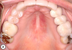 atrophic candidiasis