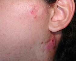 Tum faction Pr auriculaire Et Lat rocervicale Caus e Par Un Kyste Tum faction Pr auriculaire Et Lat rocervicale Caus e Par Un Kyste