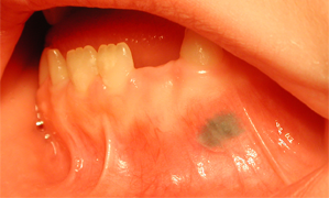 A Rare Case of Oral Mucosal Pigmentation: Differential Diagnosis and Case  Presentation | jcda