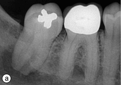 Traitement de l'engourdissement facial unilatéral | JCDA