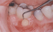 purulent exudate teeth