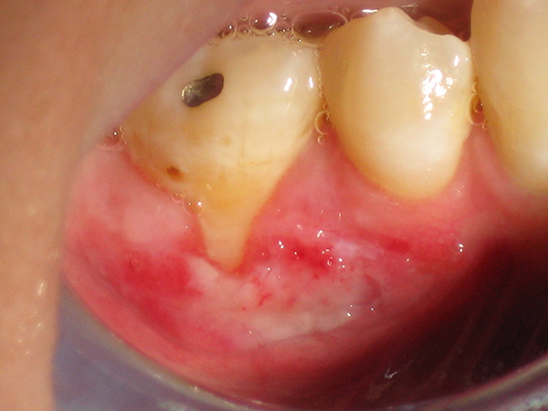 Managing Patients with Gingival Graft Failure or Loss jcda