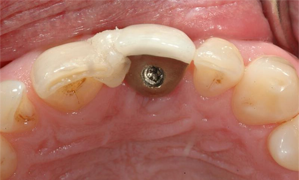 Managing Patients With A Loose Implant Abutment Screw Jcda