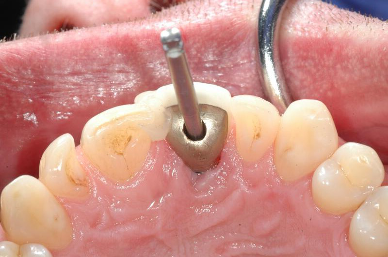 Managing Patients With A Loose Implant Abutment Screw Jcda