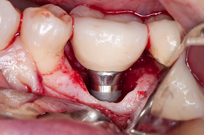 Traitement d'une péri-implantite et son suivi : est-ce réellement aussi  simple ? – L'Information Dentaire