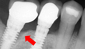 How To Manage A Loosened Dental Implant Associated With Pain Jcda