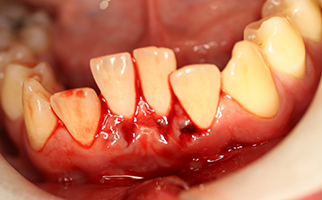 tooth luxation