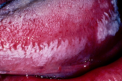 closeup of hairy leukoplakia
