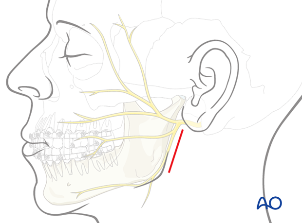 Schematic of incisions for transparotid approach