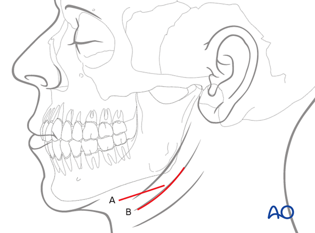 Schematic of incisions for transparotid approach