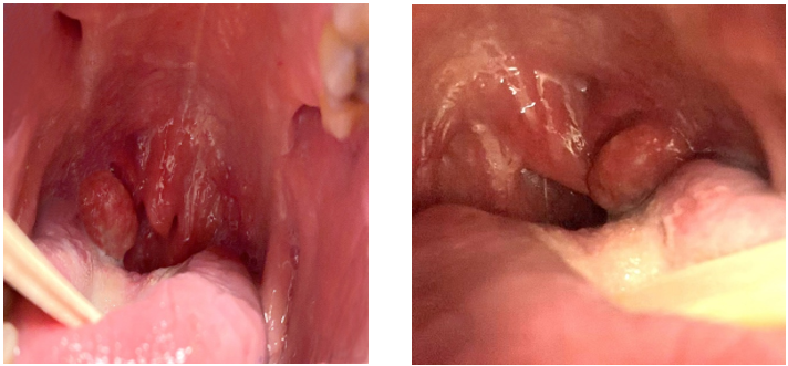 HPV present in patient's throat