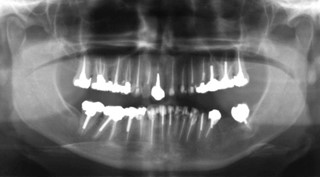 xray panoramic of teeth