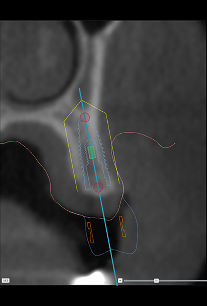 Implant planning image