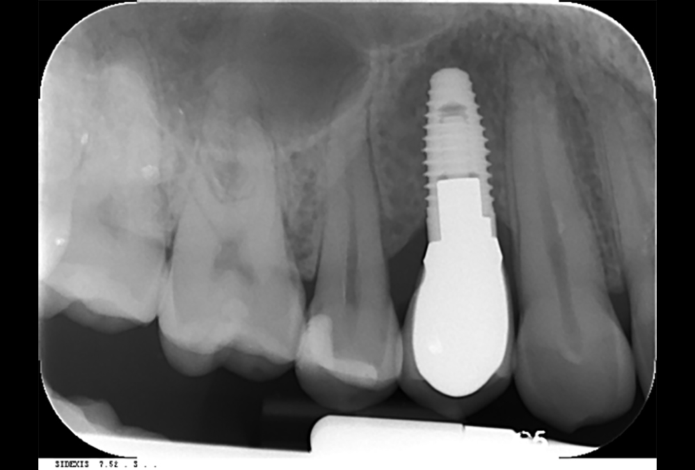 radiograph image of implant