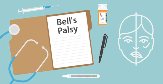 Bell's palsy illustration