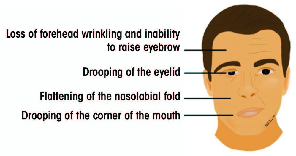 Figure 1 face with symptoms of palsy indicators
