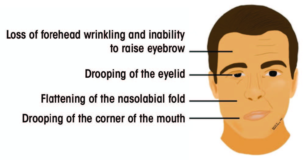 Facial nerve electrodiagnostics for patients with facial palsy: a